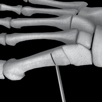 Figure 4 It is critical that the osteotomy is made perpendicular to the metatarsal shaft, and is only taken through about 70% of the metatarsal leaving the lateral cortical wall