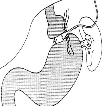 Laparoscopic Adjustable Gastric Banding (LAGB) Involves: Creation of a 15 cc gastric pouch by placing an