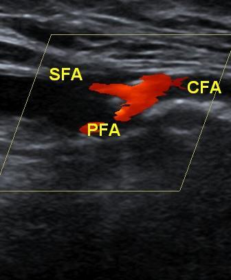 Duplex arterial ultrasound