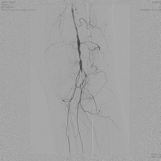 have inadequate radial strength Atherectomy channel is too small Extensive disease of the infrapopliteal arteries