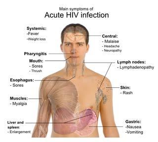 Acute HIV