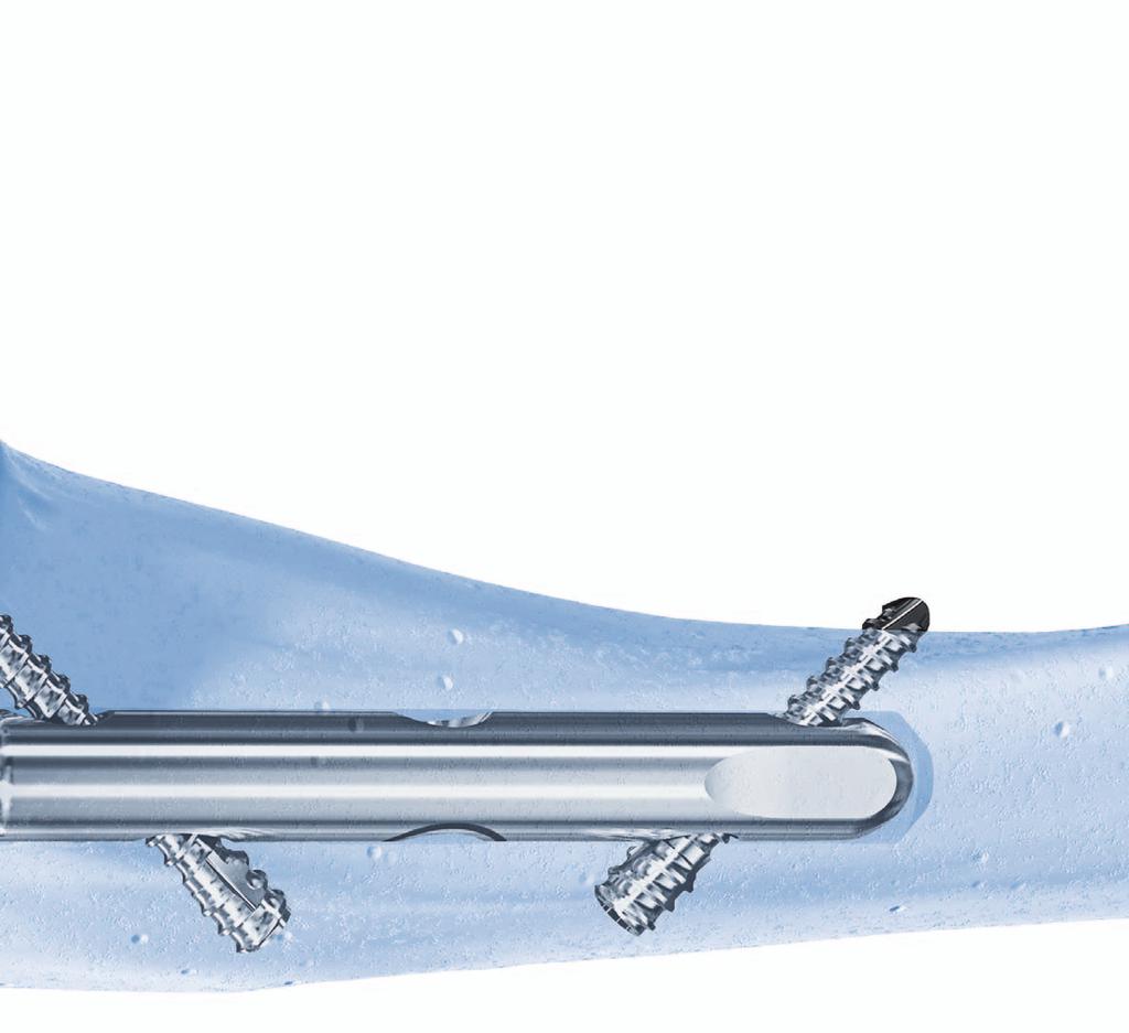 Olecranon Osteotomy Nail Pre-osteotomy fixation ensures anatomic reduction and quick realignment Easy instrumentation for simple fixation Universal right and left design Single size: Diameter 6 mm,