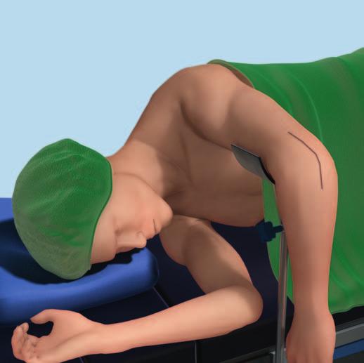 Patient Positioning Place the patient in the lateral decubitus position to