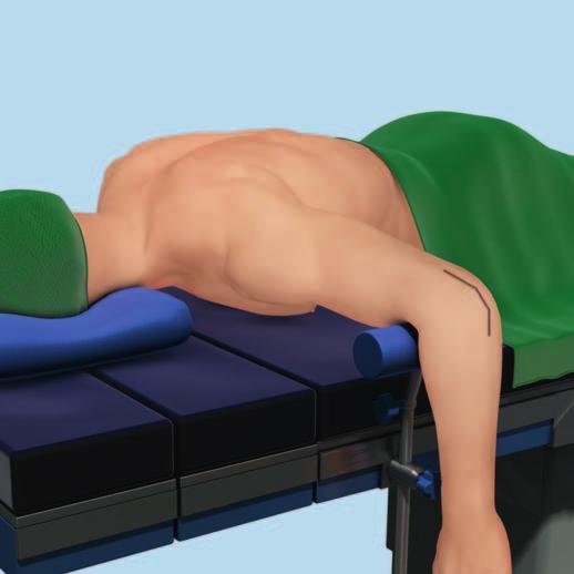 The prone position can also be selected according to the surgeon s preference and the