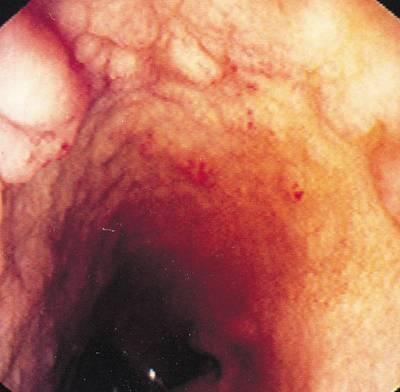 Hyperplastic gastropathies proliferative, inflammatory, and infiltrative conditions