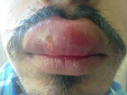 Other variants were papules, diffuse lip swelling resembling grannulomatous cheilitis and ulcers (Figure 7 & 8). Figure 7: Plaques of Leishmaniasis over lower lip and cheek.
