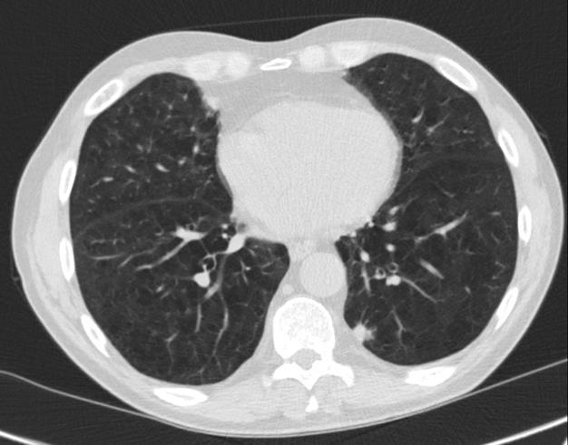 Example of lung cancer