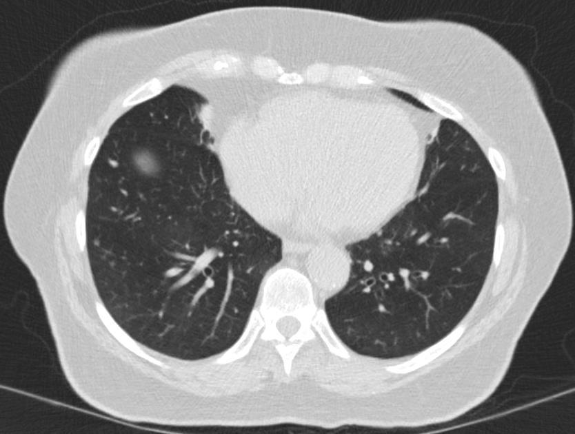 Many findings of bronchiectasis, ILD, and other cancers Patient below