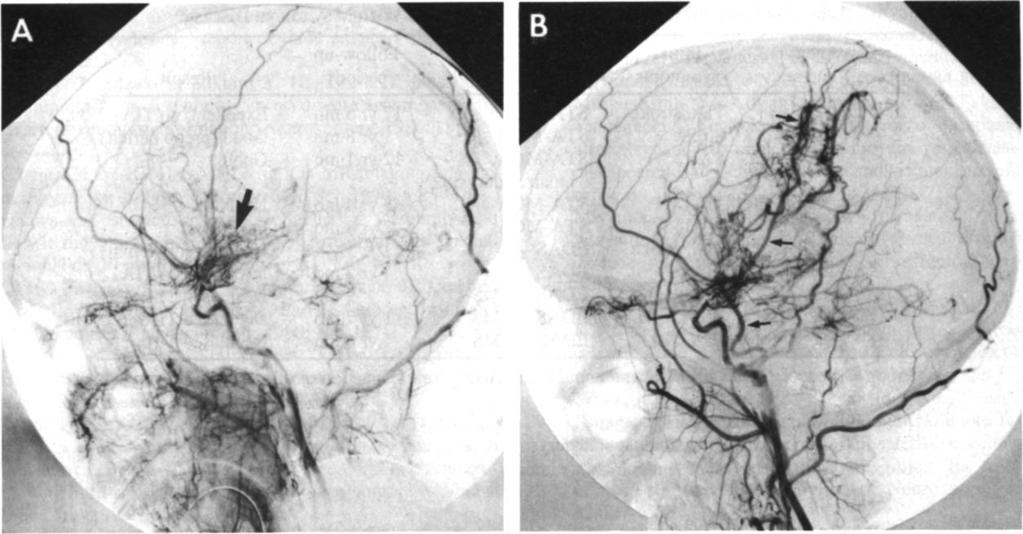 B, Postoperative lateral angiogram, demonstrating successful bypass of superficial temporal artery to middle cerebral artery and perfusion of parietal cortex (arrows).