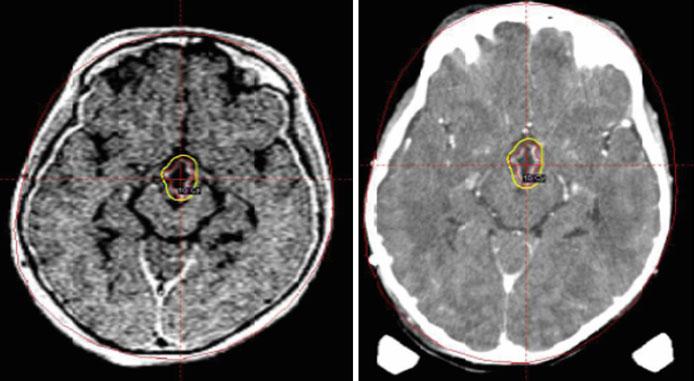 Contrastenhanced T1-weighted magnetic resonance imaging (MRI) ( a ) and computed tomography (CT) ( b ) performed at the time of radiosurgery demonstrated residual neoplastic cyst with a volume of 5.