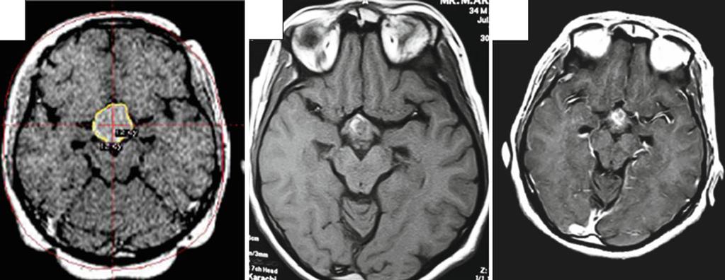 2 Contrast-enhanced T1-weighted MRI of a 32-year-old man with a solid craniopharyngioma treated with subtotal resection and subsequent GKS.