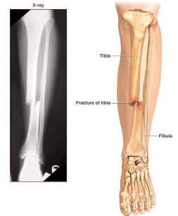 Anatomy of the lower leg The lower leg is made up of two bones namely; the Tibia and the Fibula. The Tibia and Fibula join together at both the knee and the ankle joint.