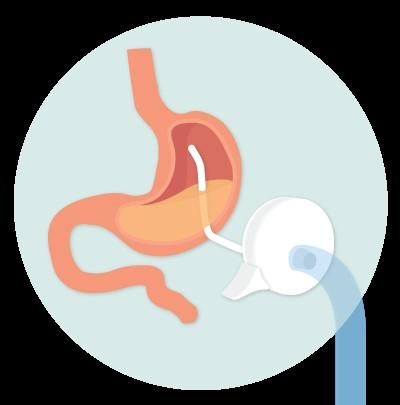 MODIFIED PERCUTANEOUS ENDOSCOPIC GASTROSTOMY TUBE TO DRAIN STOMACH This device, surgically placed in the stomach allows the patient to drain stomach contents after eating.