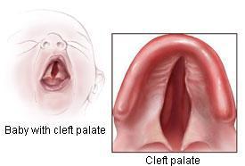 When a baby is born into the world the whole family rejoices but in the case of the cleft (lip/palate) child the parents end up in shock and sadness.