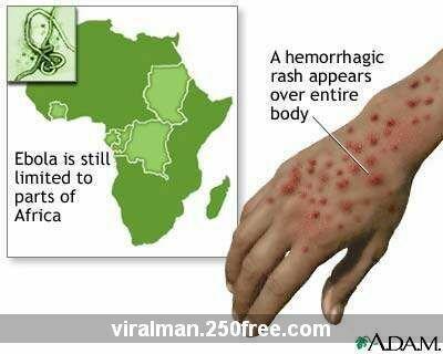 Hemorrhagic Rash http://images.google.com/imgres?imgurl=http://viralman.110mb.com/images2/ebola2.jpg&imgrefurl=http://viralman.110mb.com/gallery5.