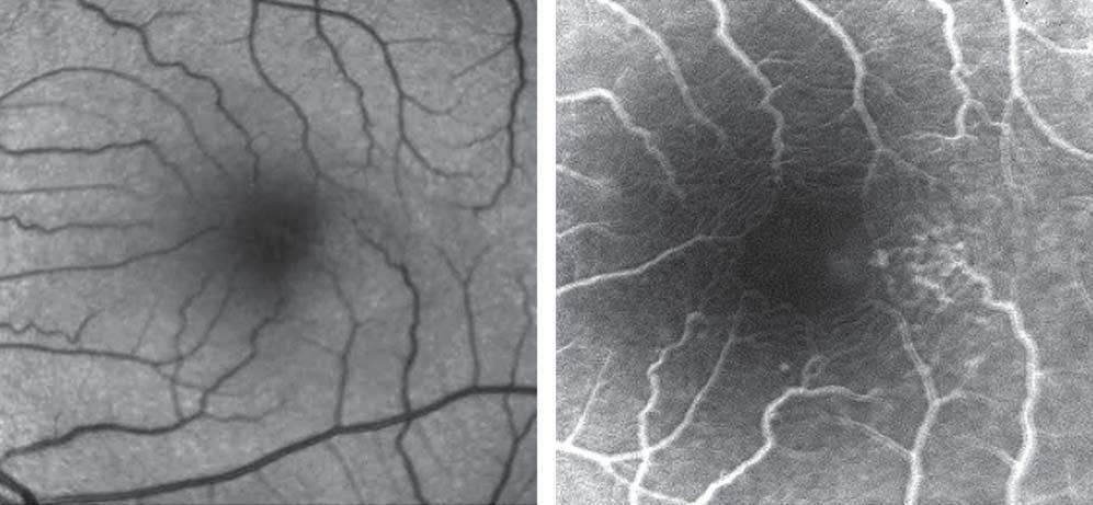 A 6-mm horizontal optical coherence tomography (OT) scan (bottom left) and detail (bottom right) only shows a small flat cyst in the inner fovea (foveal thickness is within the reference range at 168