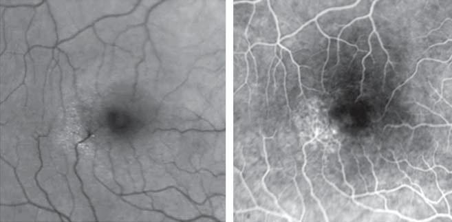 part of the fovea., A 6-mm horizontal OT scan (left) shows a large cystoid space occupying the inner fovea. The OT mapping (right) shows no foveal thickening (foveal thickness, 191 µm).