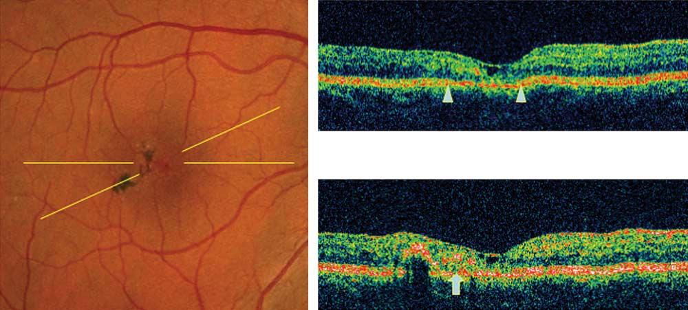 The retinal tissue remaining at the foveal center is extremely thin (central foveal thickness, 100 µm). See the Figure 1 legend for abbreviations. A O H Figure 5.