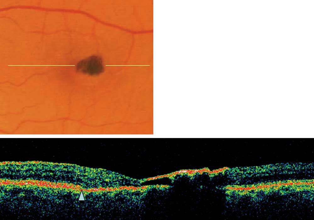Figure 7. Patient 9 (left eye) with stage 4 of group 2A IJRT. Visual acuity is 20/32.