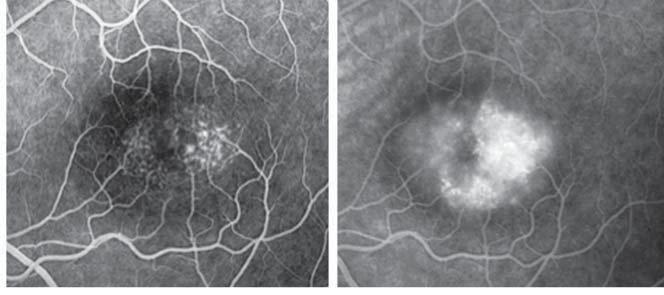 Patient 11 (left eye) with stage 3 of group 2A IJRT. Visual acuity is 20/63. , A horizontal 6-mm OT scan (bottom) shows that the fovea is detached (arrows).