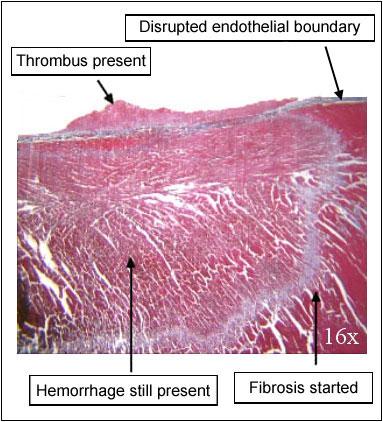 Effect on the Connective Tissue Matrix and Thrombogenicity RF Cryo Less thrombogenic.