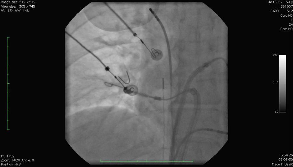 Cryoablation and Right Pulmonary Veins Phrenic nerve pacing: Beware phrenic nerve palsy Complete RIPV occlusion with