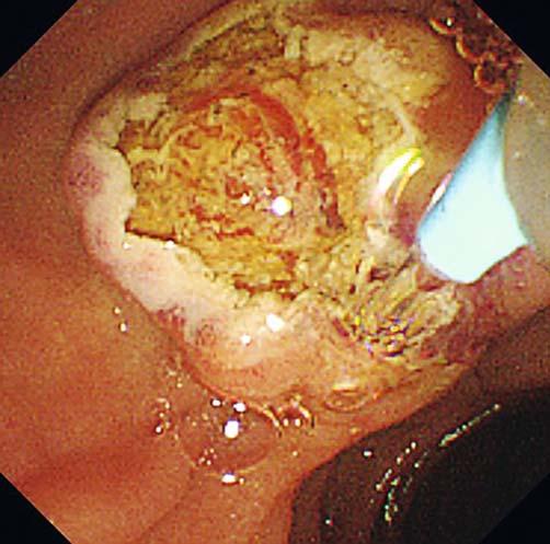 Fig.3 Endoscopic image showing a marking placed slightly before the upper margin of the bulge of the papilla in the 11- to 12-o clock direction as a cutting endpoint by cauterization with