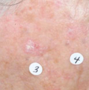 About Actinic Keratoses Up to 58 million Americans have actinic keratosis (AK).