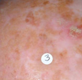 AKs often called sun spots are rough-textured, dry, scaly patches on the skin caused by excessive exposure to