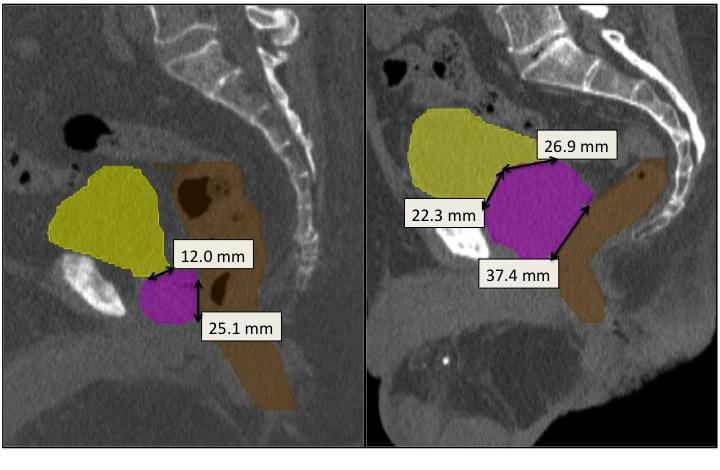 165 Descovich et al.: Dose constraints for prostate SBRT 165 Fig. 1. Anatomy of prostate patients. Examples of favorable (left) and unfavorable (right) patient anatomy for a prostate SBRT treatment.