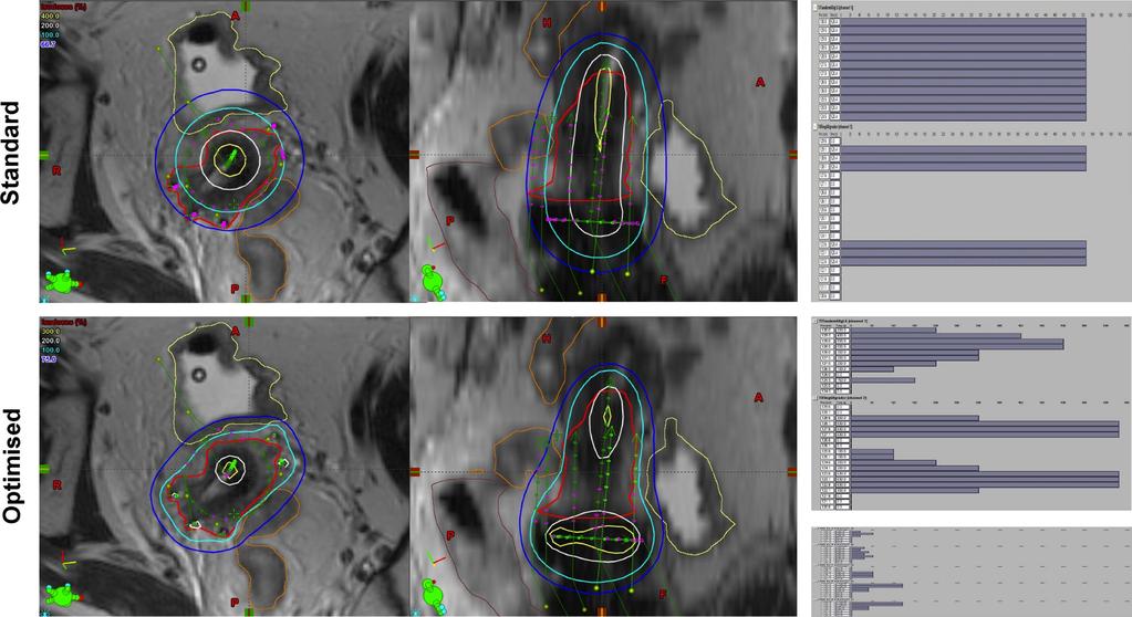 11 MRI-based 4D IGBT: IC/IS optimisation Significant dose