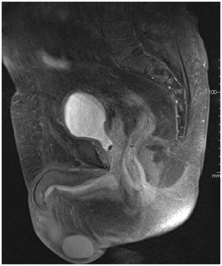 1234 Journal of International Medical Research 46(3) Figure 1 shows a sagittal view of the prostate and prostatic urethra at 1 month.