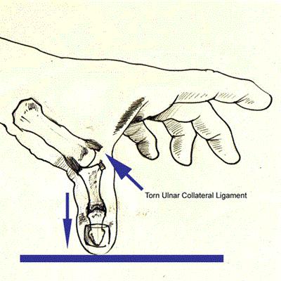 Acute = Skier s Thumb Chronic = Gamekeeper s Thumb Surgery is