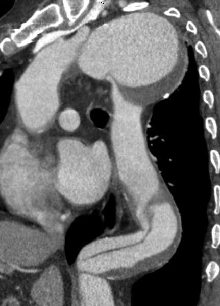 Case 1 56-year-old female Type B Aortic dissection 3 years ago Thoracic Aortic