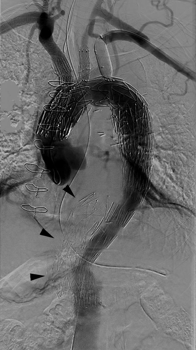 Branched Endografts for Arch Post- Dissection Aneurysms 2012-2016 => 48 patients with Arch branched endografts 20 patients with Arch dissections post open ascending repair Indications: chronic