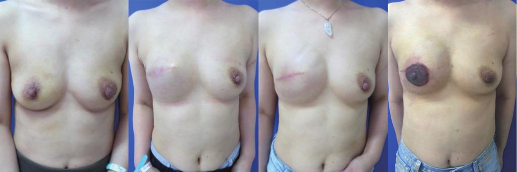 (A) Pre-operative pictures; (B) after skin-sparing mastectomy and immediate expander reconstruction, the patient s expander was injected with saline bi-weekly with satisfied appearance; (C) the