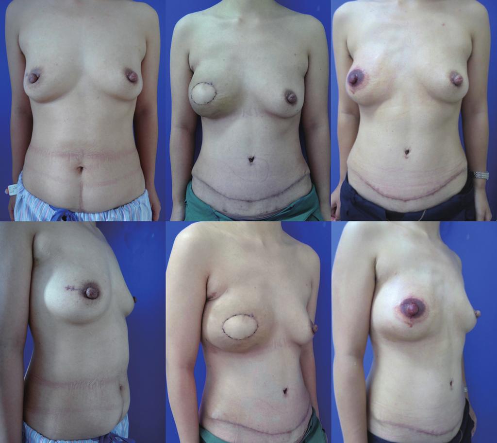 8 Huang et al. Current status of breast reconstruction in China A C E B D F Figure 4 Muscle-sparing free TRAM flap reconstruction.