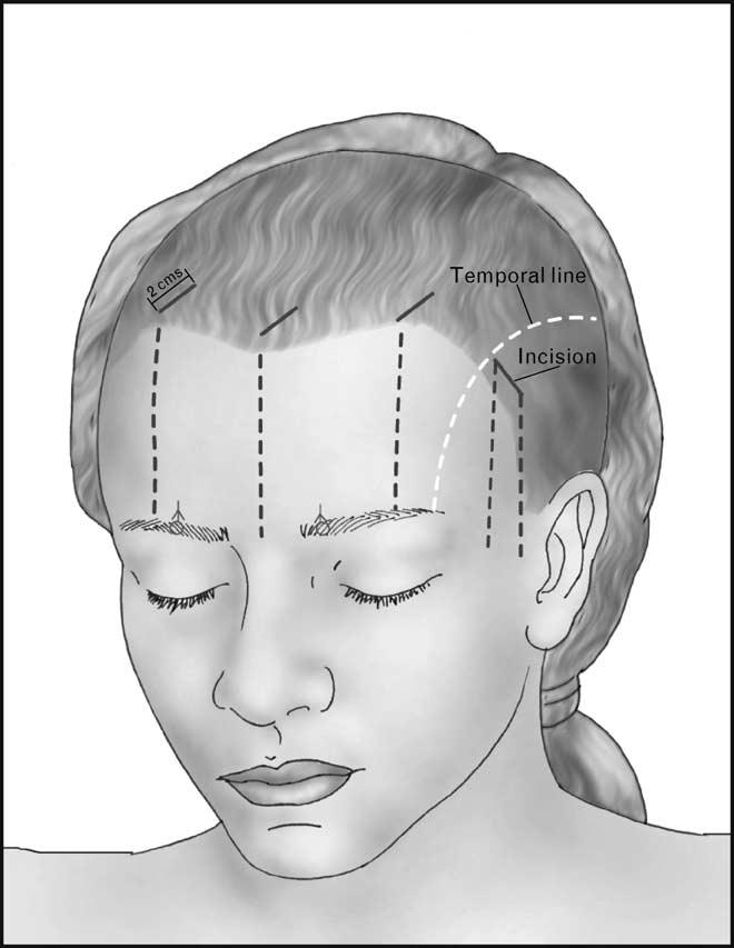 284 Facial plastic surgery The surgical routine of the senior author (F.P.) involves palpating and marking the supraorbital foramen before the procedure.