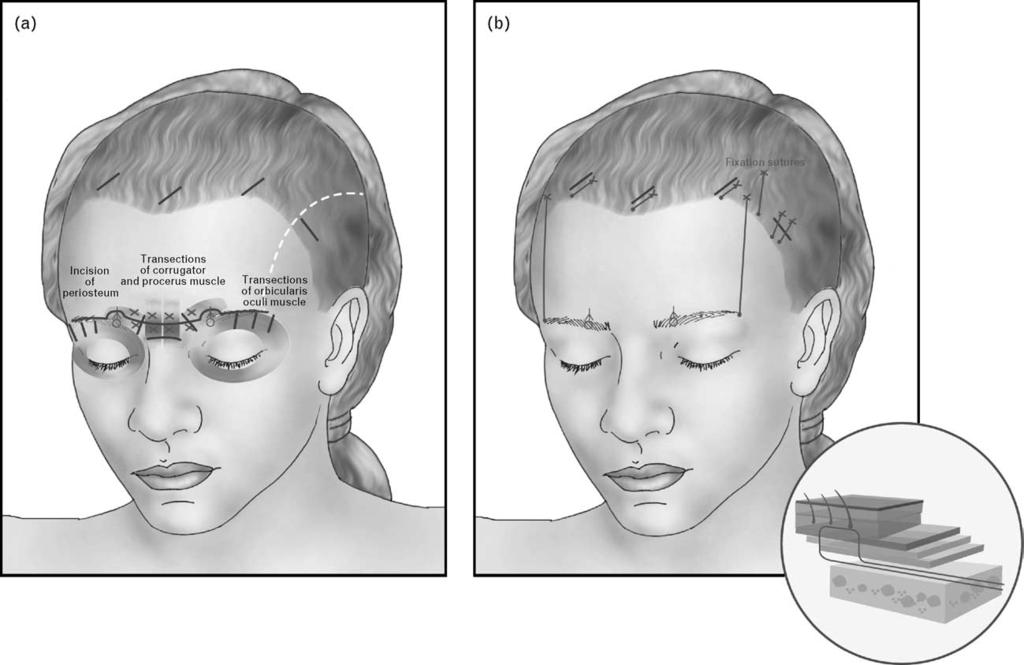 Update on brow and forehead lifting Pedroza et al.