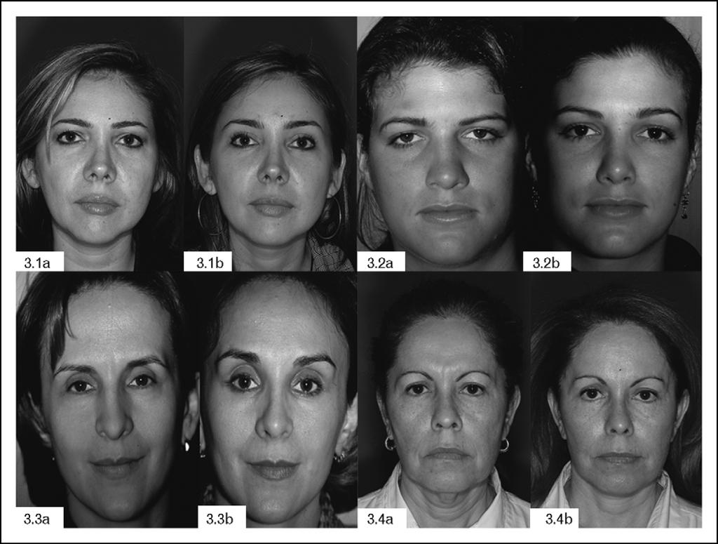 286 Facial plastic surgery Figure 3 Pre and postoperative photographs (3.1 3.4a) Preoperative photographs. (3.1 3.4b) Postoperative photographs, 1 year after the frontoplasty technique, carried out by the senior author.