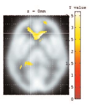cingulate anticipatory anxiety in PD patients cortex during