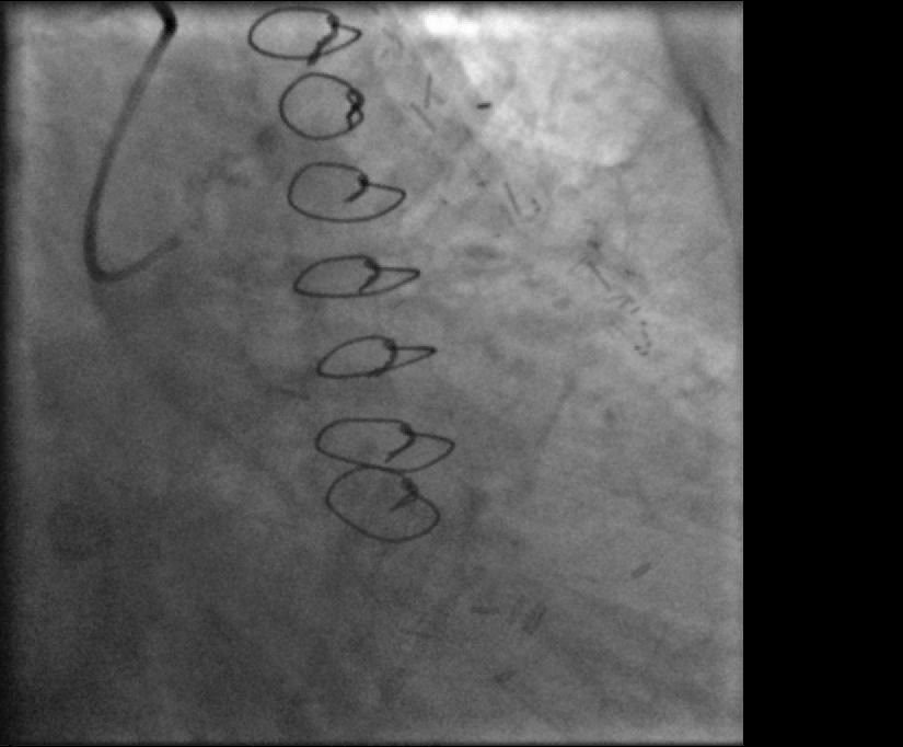 Putting it all together: Native coronaries + grafts + complex PCI
