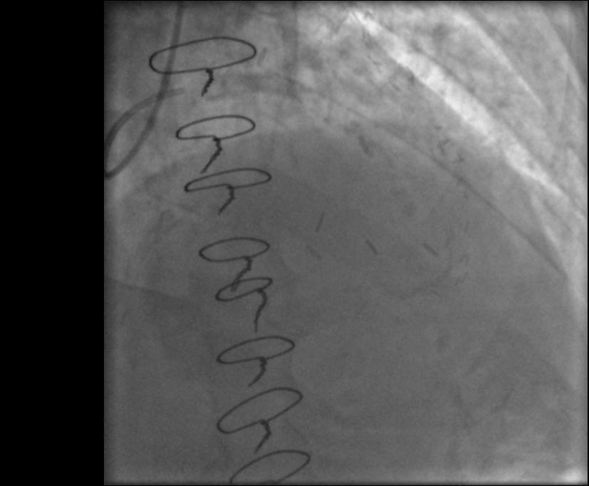 SVG OM1), EF 20%, severe PVD pre-op for surgical lower extremity