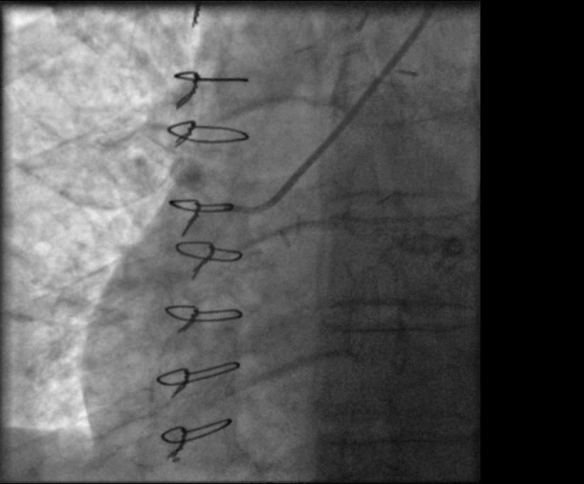 Putting it all together: Native coronaries + grafts + complex PCI from the