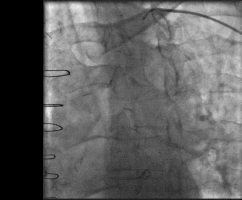 man with a history of CABG (LIMA LAD, SVG RCA, SVG OM1), EF 20%, severe PVD