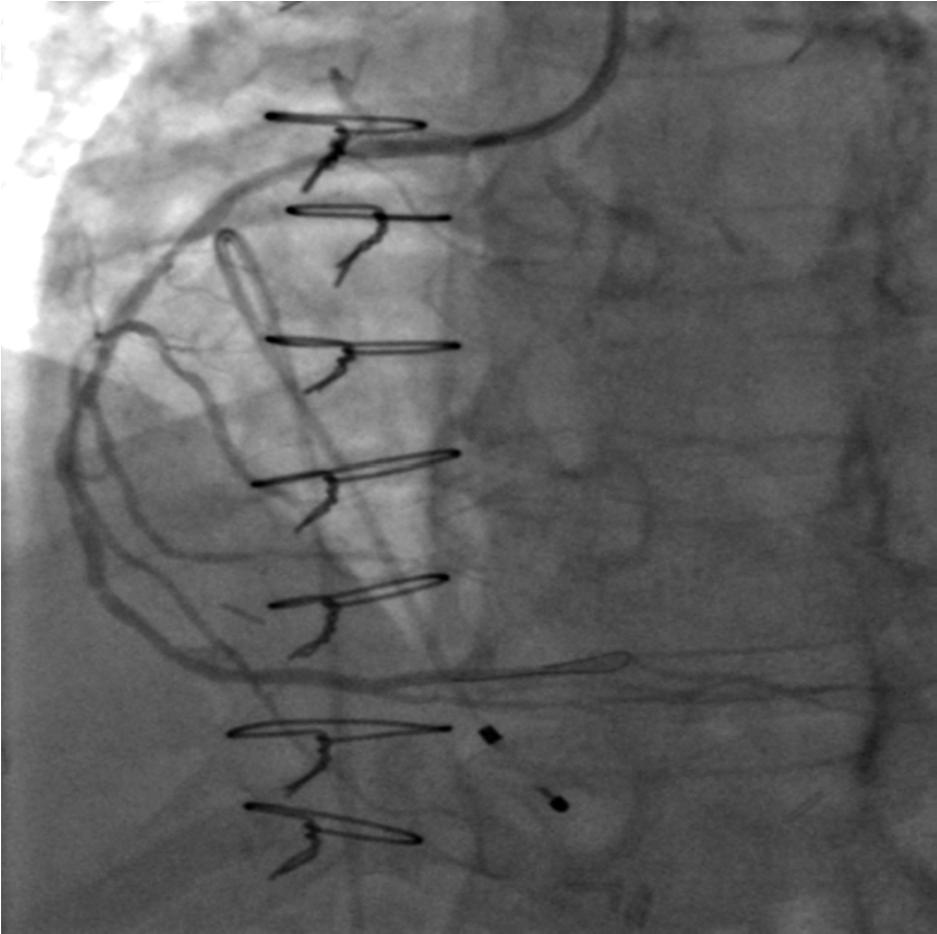 onaries + grafts + complex PCI from the wrist 69 y.o. man with a history of CABG (LIMA LAD, SVG RCA, SVG OM1), EF 20%, severe