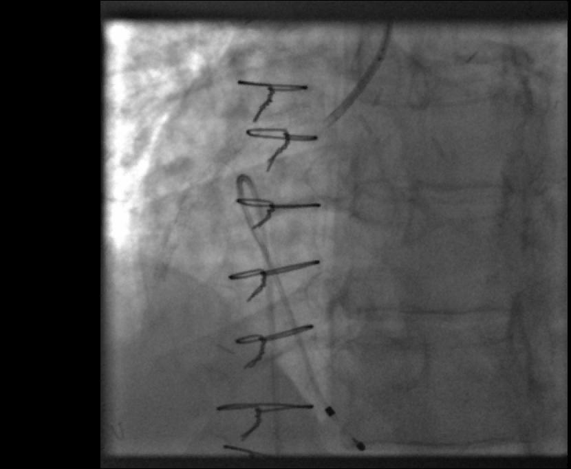 man with a history of CABG (LIMA LAD, SVG RCA, SVG OM1), EF 20%, severe PVD