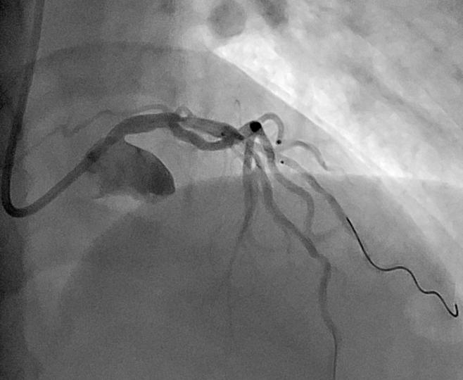 Guide catheter choices: EBU Workhorse curve for left coronary artery Sizing suggestions: JL3.