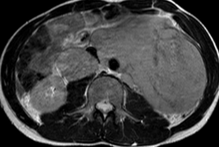 CASE 2: 26 year old, abdominal pain and weight loss NEUROBLASTOMA/GANGLIOBLASTOMA Most frequent malignant tumour of the medulla= Small round blue cell tumor of