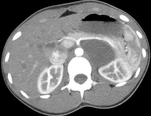 pattern for adenoma and not a cyst on CT